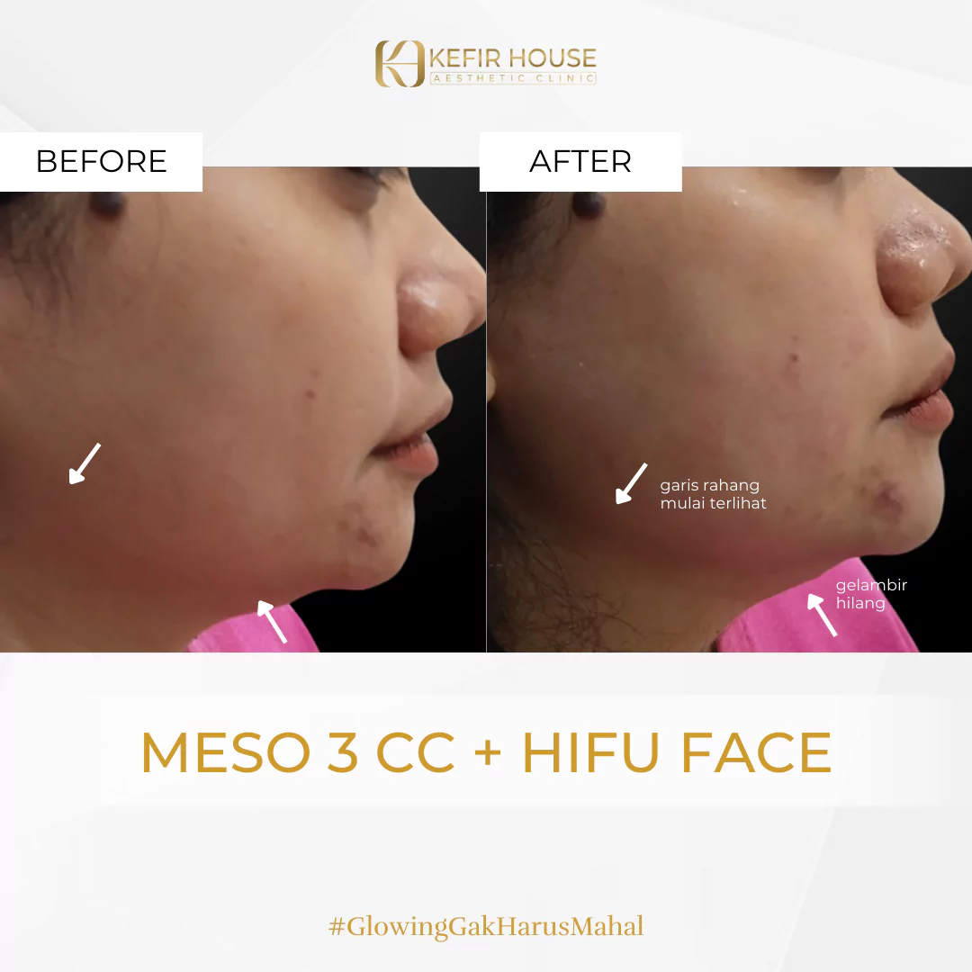 Meso dan HIFU Treatment