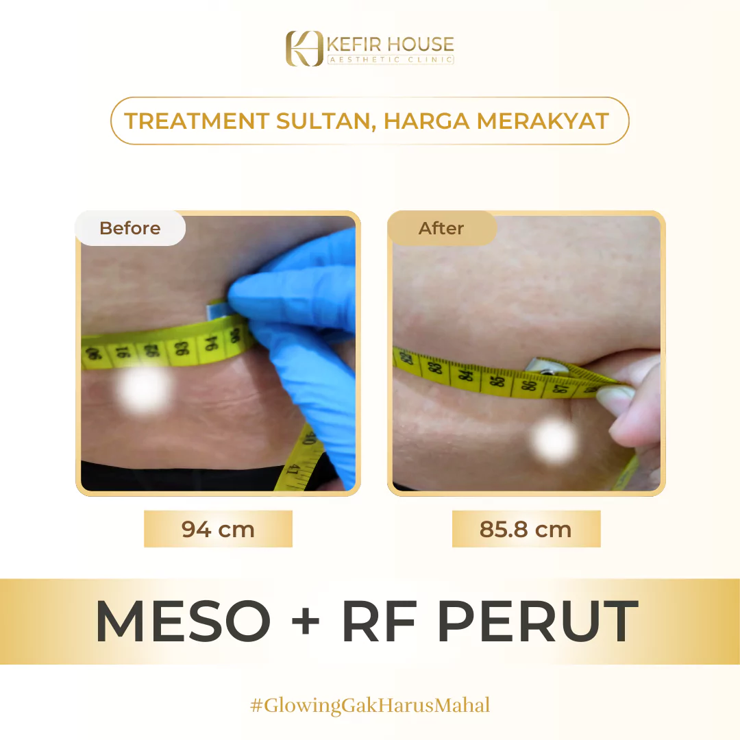Meso dan RF Perut Before After