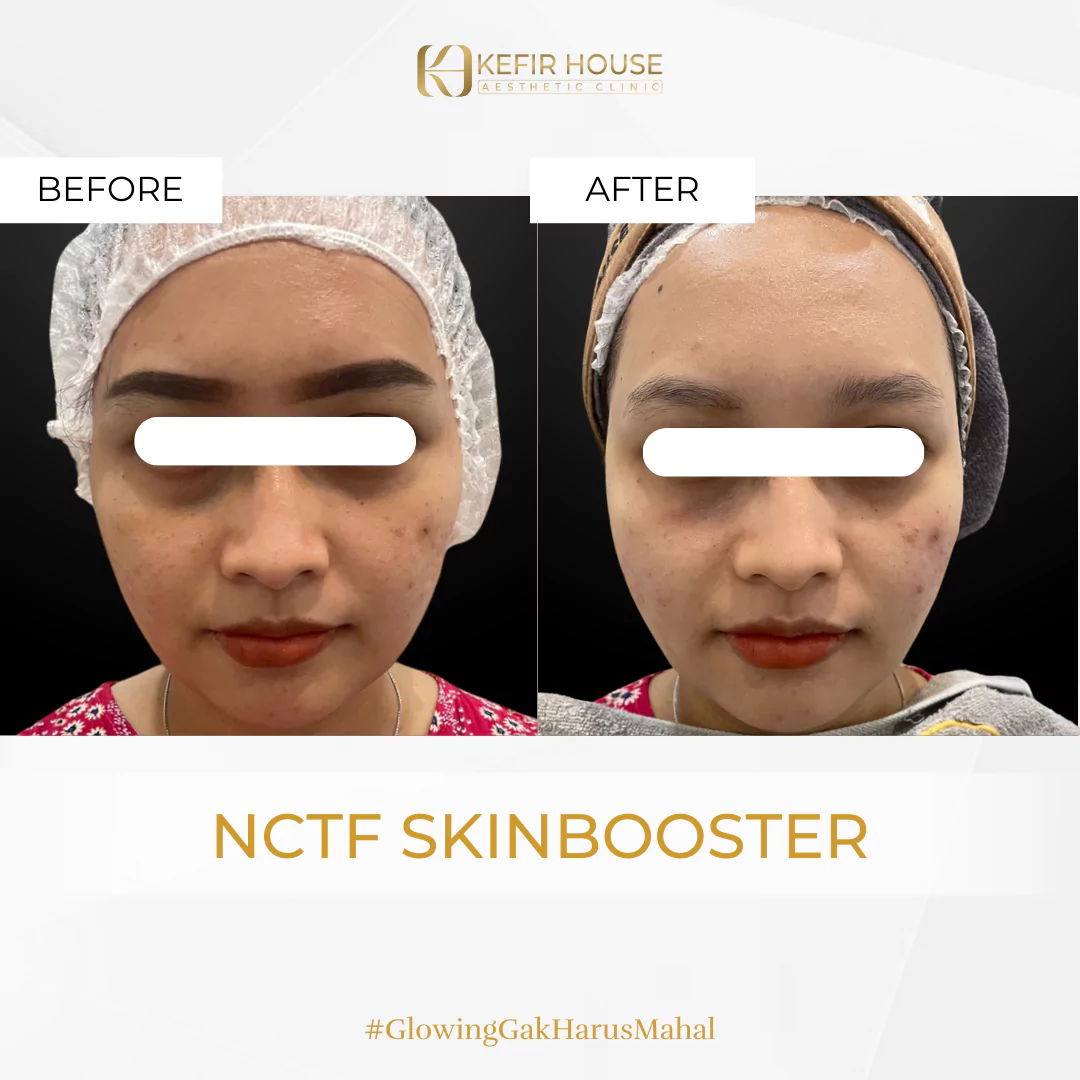 NCTF Skin Booster 2 Before After