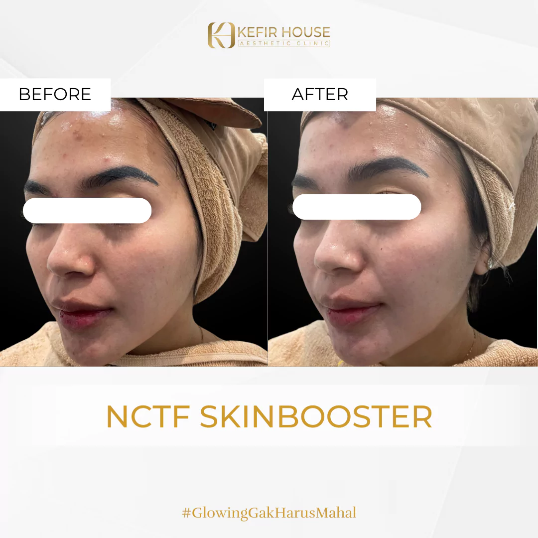 NCTF Skin Booster 1 Before After